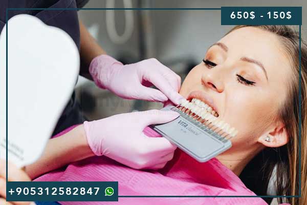 Facettes Dentaires en Turquie 2025 : Guide Complet des Prix, Techniques et Cliniques Recommandées