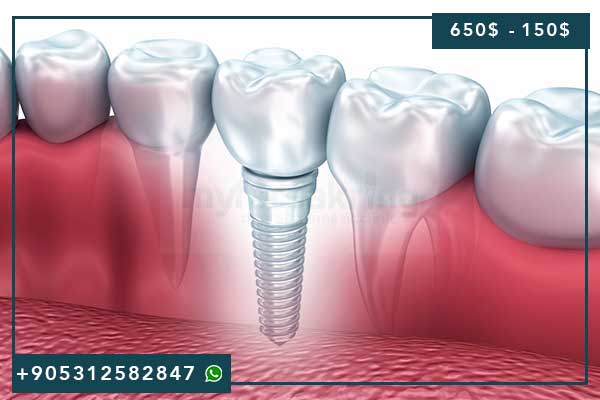 Esthétique Dentaire en Turquie 2025 : Guide Complet des Soins, Prix et Innovations