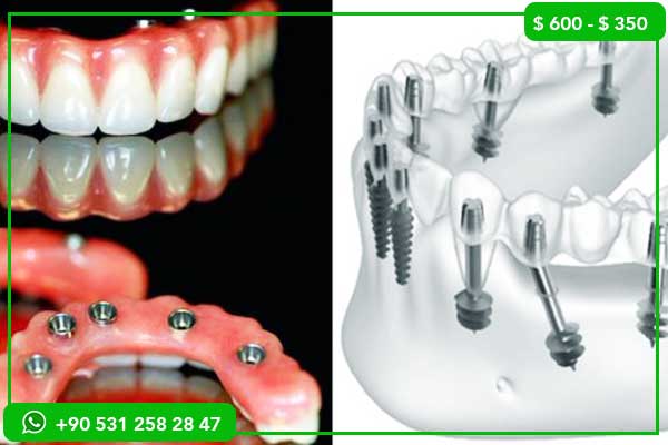 Implants Dentaires en Turquie 2025 : Guide Complet pour une Transformation Révolutionnaire de Votre Sourire