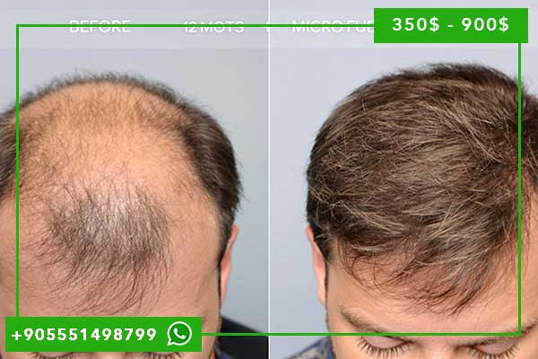 Implantes Capilares en Turquía 2025: Guía Completa de Técnicas, Precios y Mejores Clínicas