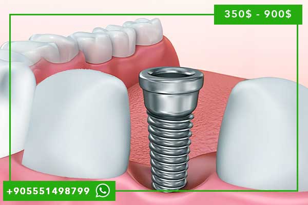 Implantes Dentales en Turquía 2025: Precios, Calidad y Experiencia Completa