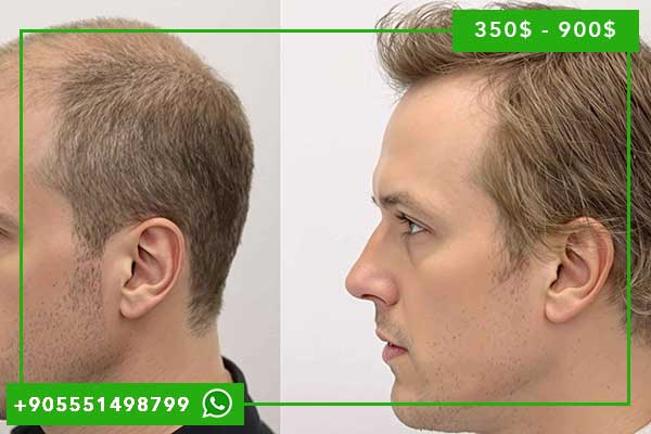 Mejores Clínicas de Trasplante Capilar en Turquía 2025: Guía Completa Actualizada