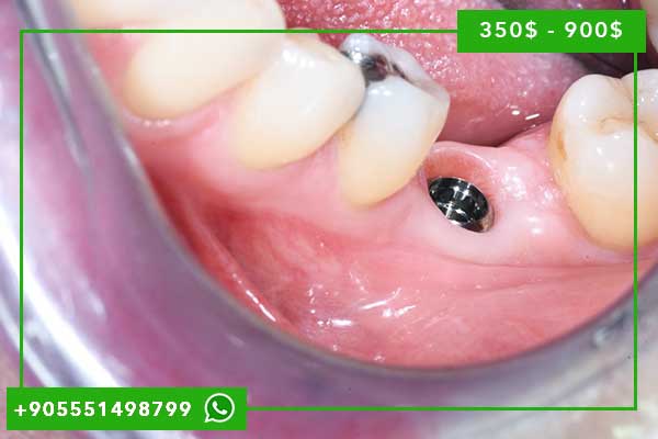 Tratamiento Dental en Turquía 2025: La Guía Completa para el Turismo Dental