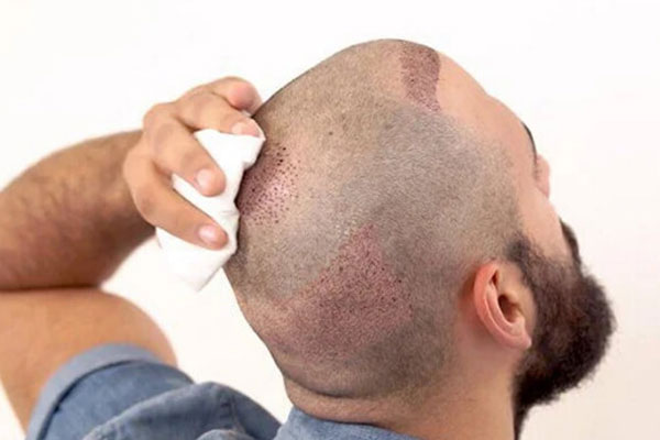 Implante Capilar en Turquía: Opiniones y Experiencias Reales 2025 – Guía Completa