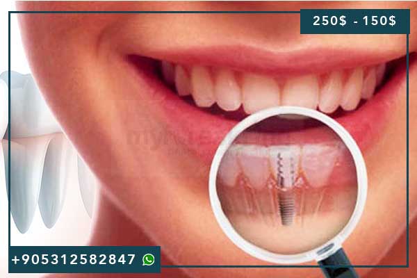 Combien Coûtent les Implants Dentaires en Turquie en 2025 : Guide Complet des Prix et Techniques Révolutionnaires