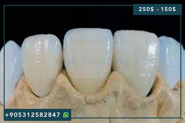 🦷 Facettes Dentaires Prix Turquie 2025 : Guide Complet des Tarifs et Meilleures Cliniques d&rsquo;Istanbul ✨