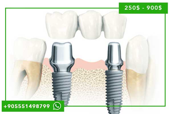 🦷 Implant Dentaire Istanbul Coût 2025 : Guide Complet des Prix et Meilleures Cliniques | Économisez jusqu&rsquo;à 75% !