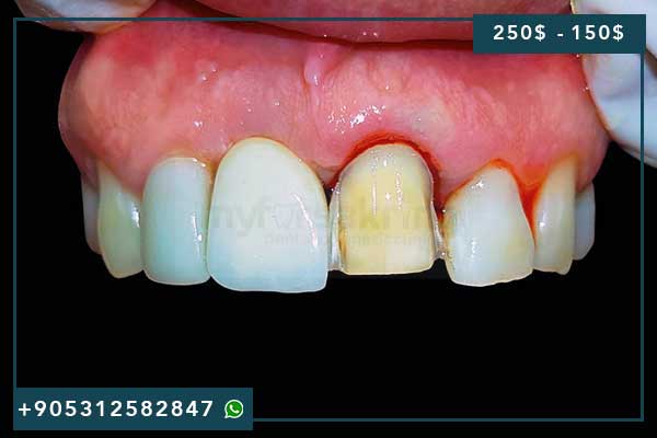 🦷 Meilleure Clinique Implant Dentaire Turquie 2025 : Guide Ultime pour des Soins d&rsquo;Excellence à Prix Imbattables ✨