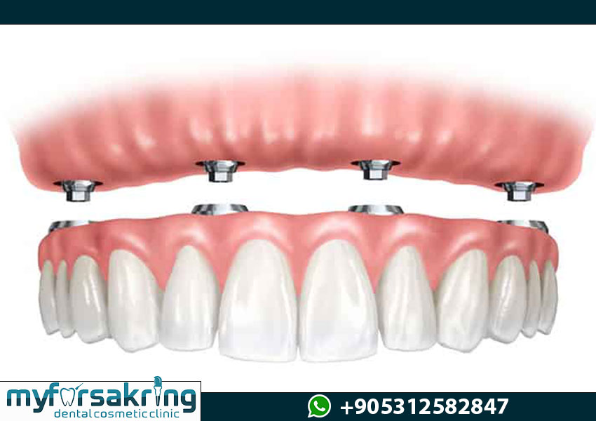 Pristine Surgical Preparation for All on 4 Implants