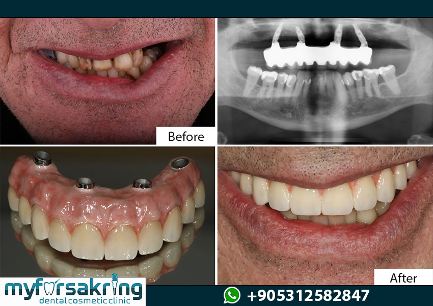 Final Functional Smile Result All on 4 Turkey