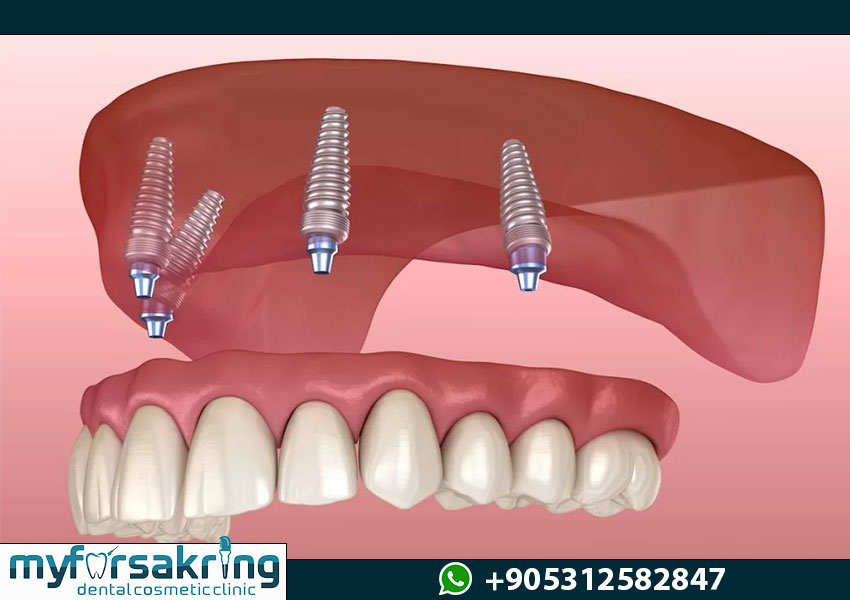 All-on-4 Dental Implants Structural Layout Turkey