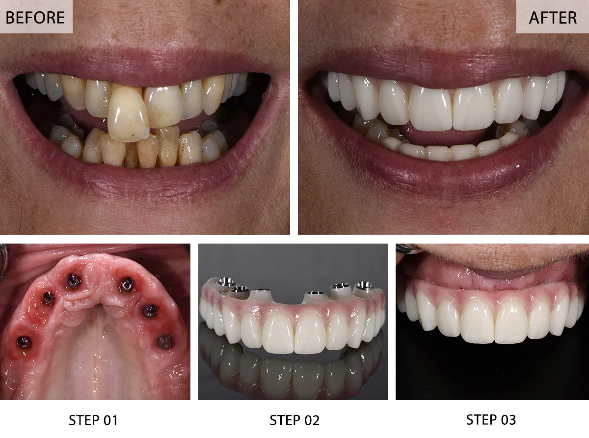 All-on-6 Dental Implants Before and After Patient Transformation