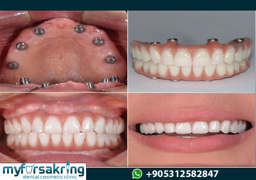 all on 6 dental implants turkey : Cost Full Mouth Dental Implants Turkey