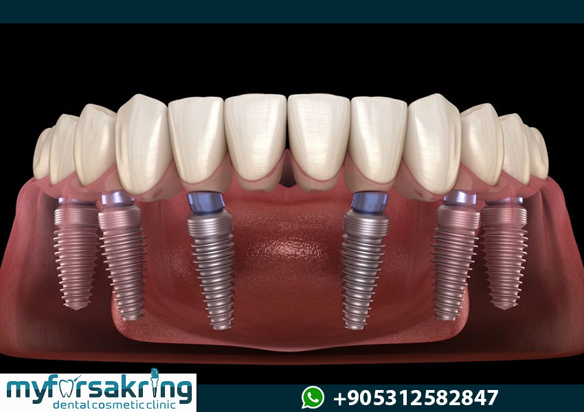 All-on-6 Dental Implants Structural Mechanics Turkey
